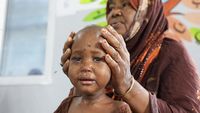 Anak-anak Somalia menunjukkan tanda-tanda malnutrisi akut di sebuah kamp pengungsian, sebuah cerminan krisis kemanusiaan yang diperparah oleh kekeringan, konflik, dan gangguan pada rantai pasok bantuan global.